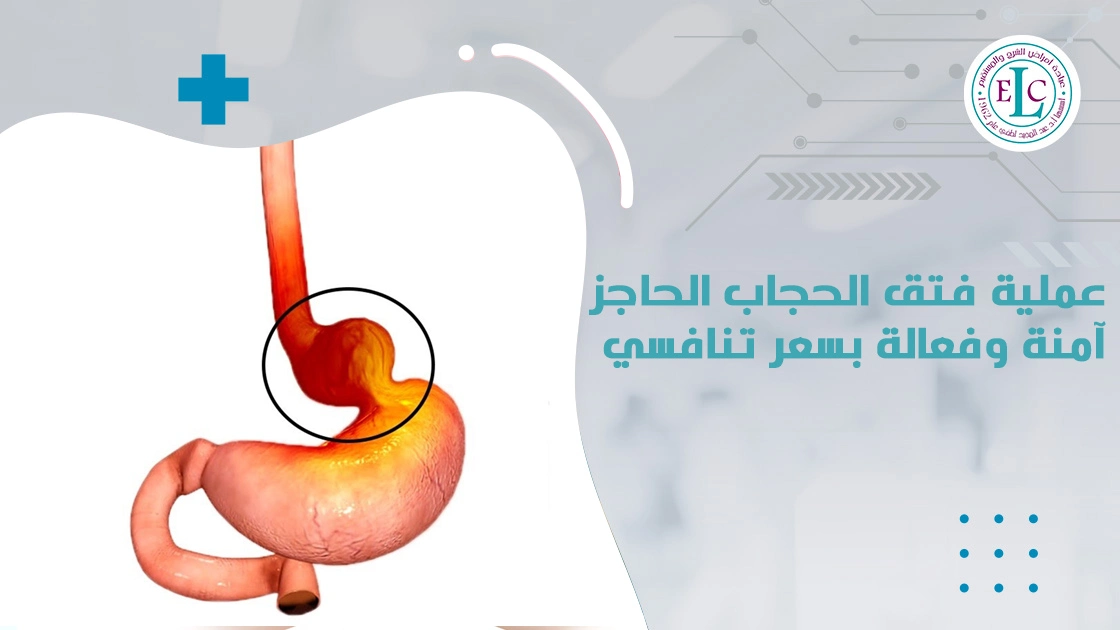 عملية فتق الحجاب الحاجز