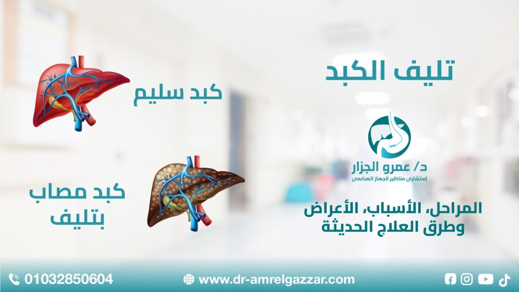 تليف الكبد: المراحل، الأسباب، الأعراض وطرق العلاج الحديثة
