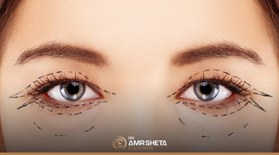 تجميل الجفون في مصر