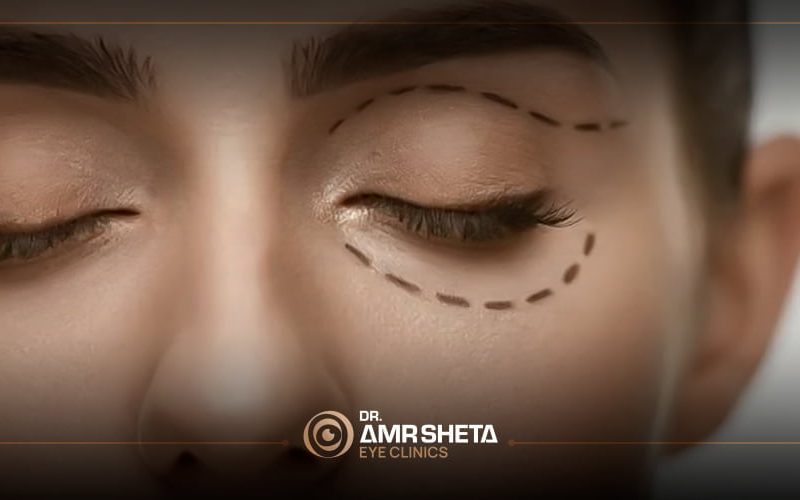 blepharoplasty