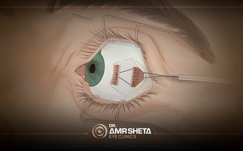 علاج-بإجراء-عملية-جراحية
