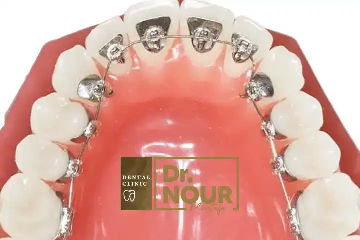 تقويم الاسنان الداخلي