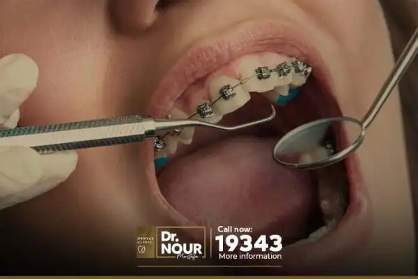 شروط وطريقة تركيب تقويم الاسنان شروط وطريقة تركيب تقويم الاسنان