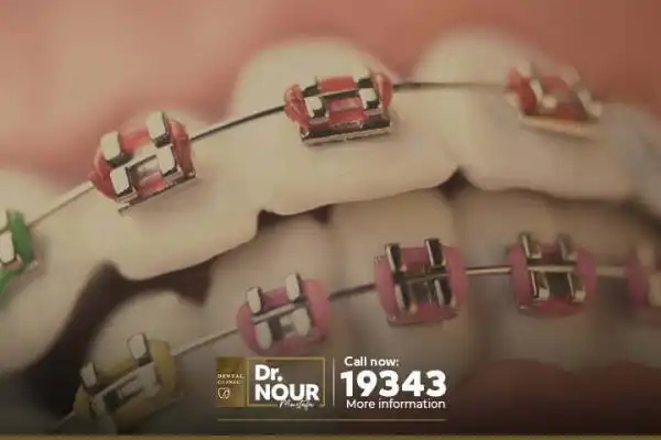 فوائد تقويم الأسنان فوائد تقويم الأسنان