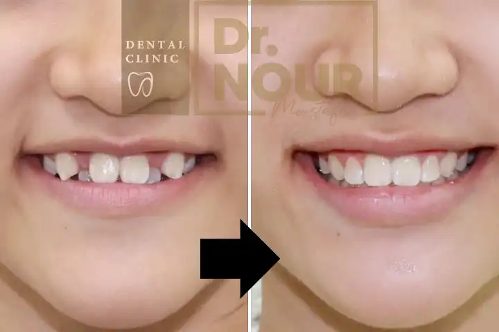 نتيجه قبل وبعد تقويم الاسنان مع دكتور نور