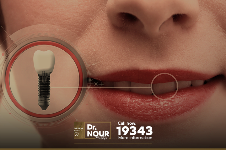 زراعة الاسنان مناسبة لجميع حالات فقد الاسنان