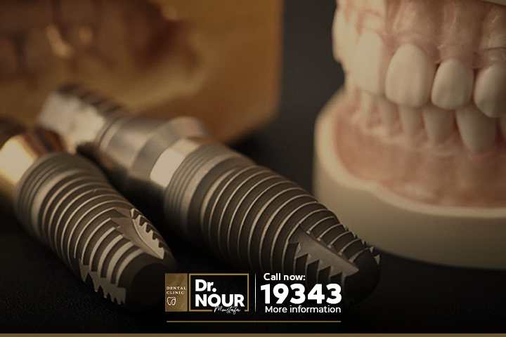 لماذا زرع الاسنان افضل من تركيب الاسنان