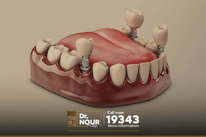 زراعة الاسنان