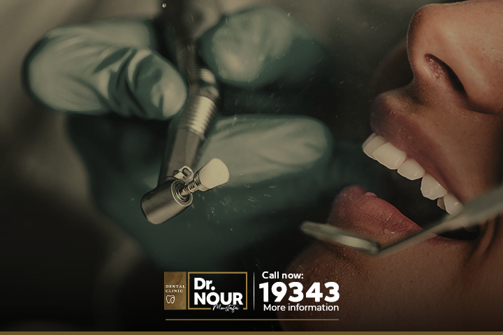 أفضل انواع القشور التجميلية لصنع هوليود سمايل وزرع الاسنان