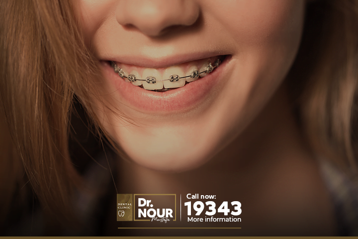 اهم انواع تقويم الاسنان ومزاياها وعيوبها