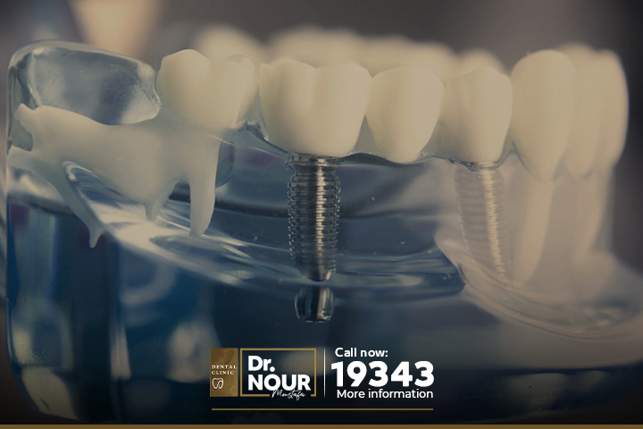 زراعة الأسنان في 10 دقائق فقط!