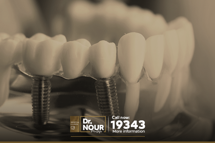 كيف يلتحم العظم في زراعة الاسنان مع مادة التيتانيوم