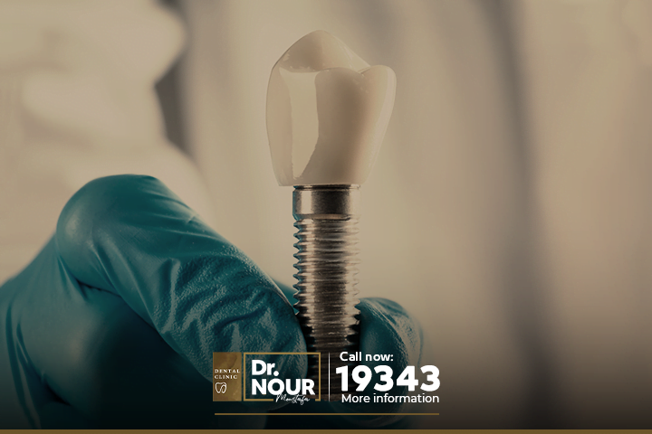 طريقة زراعة الاسنان