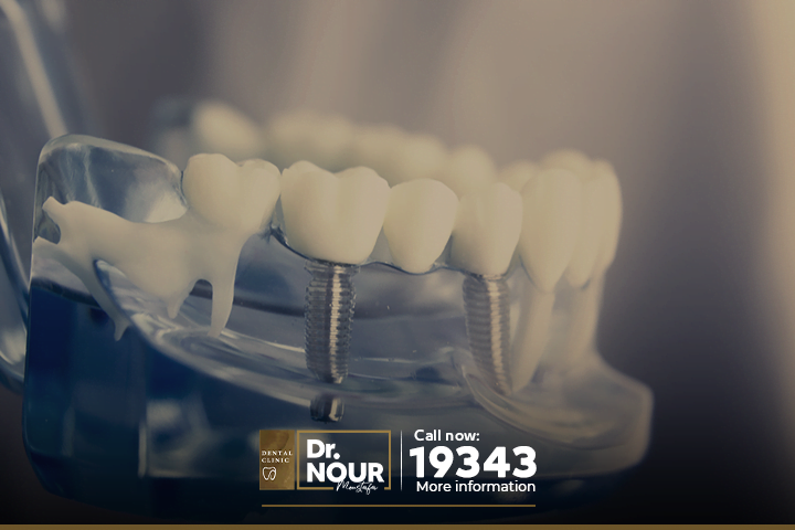 فوائد ومزايا زرع الأسنان