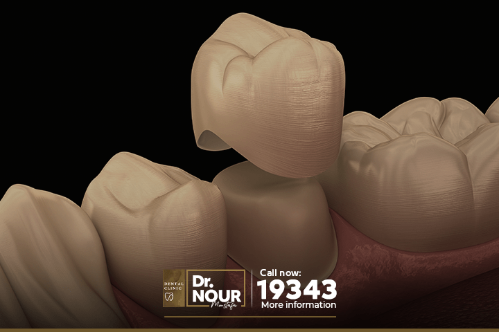 افضل انواع تركيبات الاسنان الثابتة