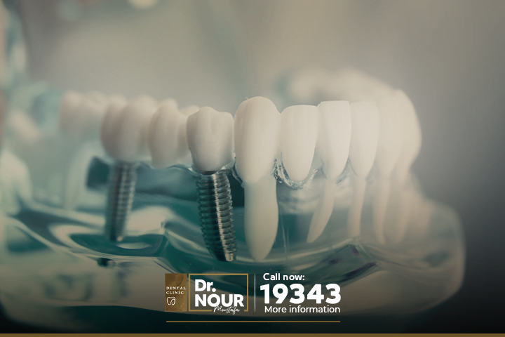 زراعة الاسنان وشروطها