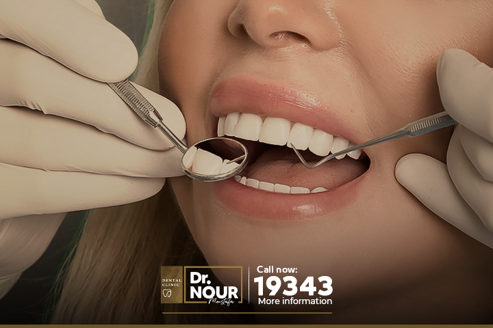 زرع الاسنان الامامية وابتسامة هوليود