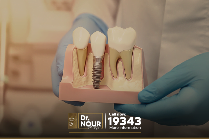 اصلاح عيوب زراعة الاسنان بمركز وايتى