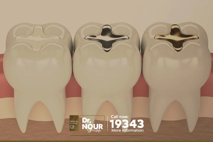 افضل أنواع حشو الأسنان واسعارها