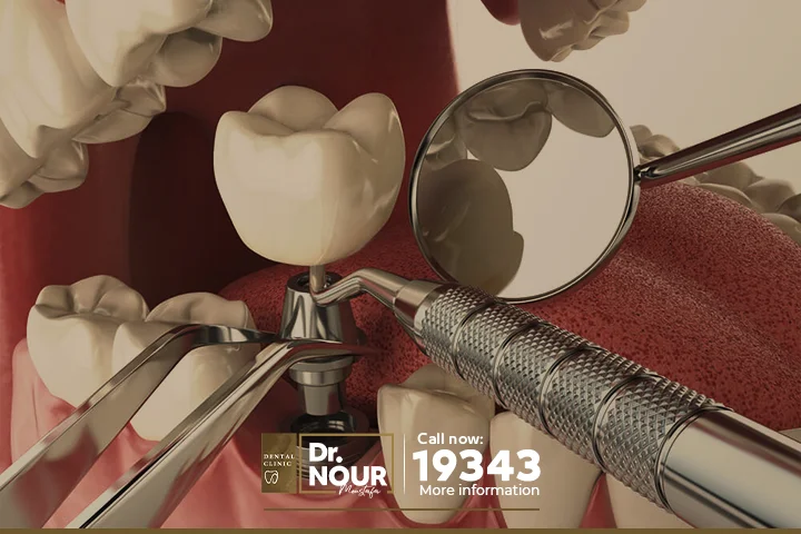 تكلفة زراعة الأسنان كاملة في مصر