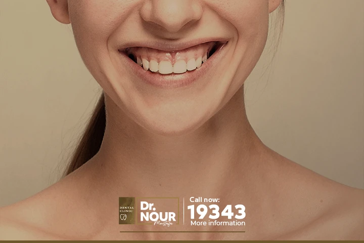 تكلفة علاج الضحكة اللثوية في مصر