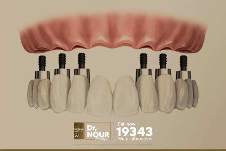 زراعة الأسنان الأمامية العلوية