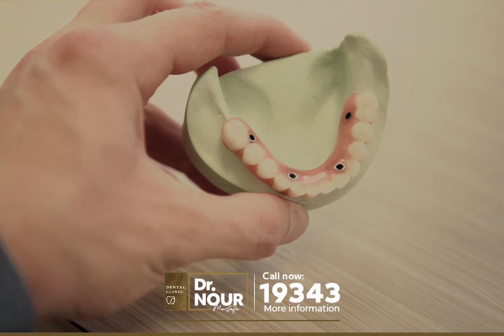 ما هي أفضل أنواع زراعة الأسنان عالمياً لعام 2023