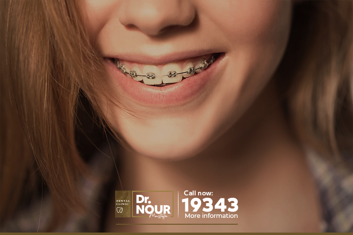 تكلفه تقويم الاسنان بمصر