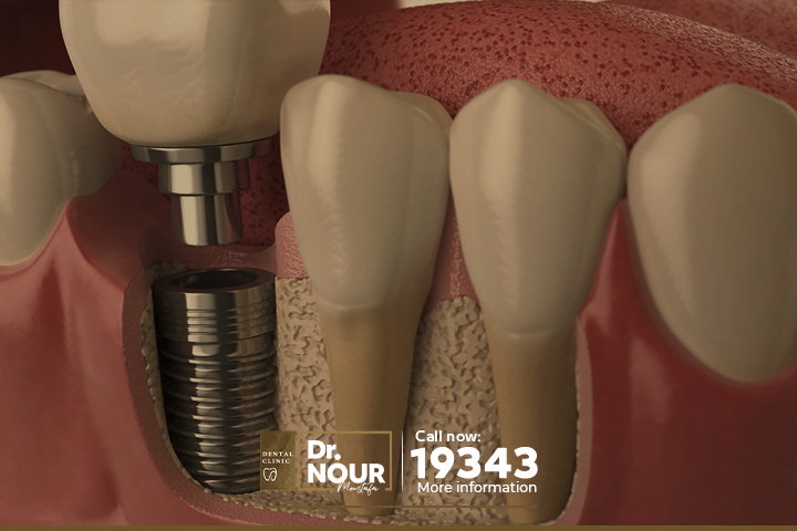 ما هو سعر تركيب ضرس واحد في مصر 2023