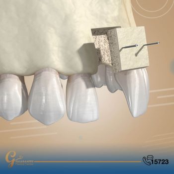زراعة عظم الفك
