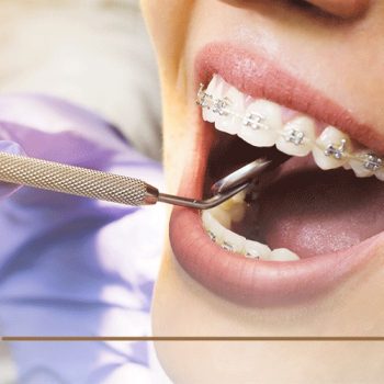 علاج التهاب اللثة – دليل شامل لما تود أن تعرفه