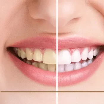 كيف اجعل اسناني ناصعة البياض