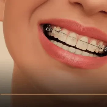 التقويم الشفاف للاسنان
