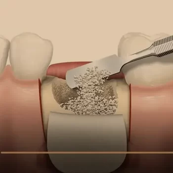 نسبة نجاح زراعة عظم الفك