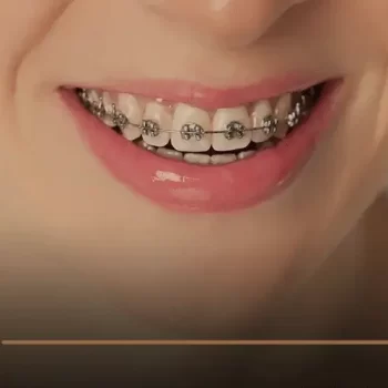 تقويم اسنان للفك العلوي فقط