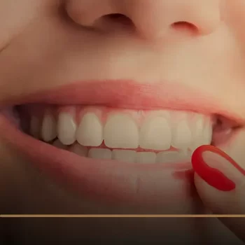 شكل الاسنان بعد الزراعة