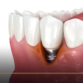 Dental implant